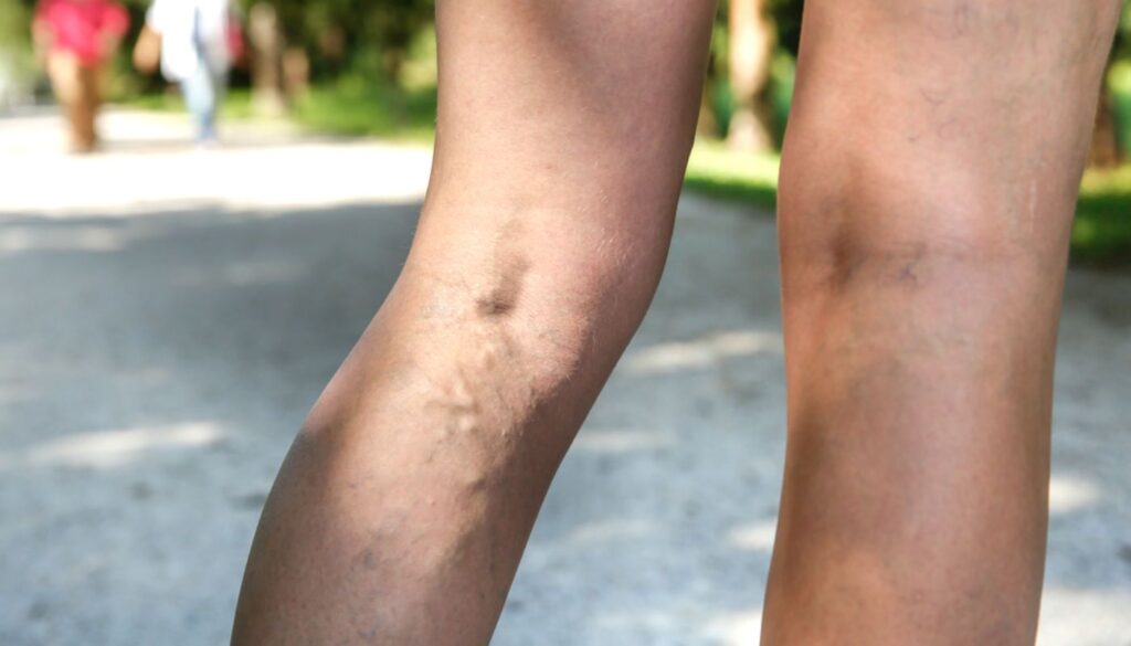 Questa pianta migliora la circolazione sanguigna nelle gambe e migliora le vene varicose.