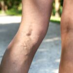 Questa pianta migliora la circolazione sanguigna nelle gambe e migliora le vene varicose.